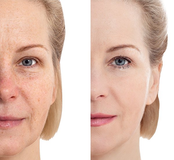 Trattamento anti-age